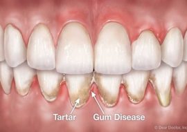 Periodontal Gum Disease