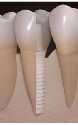 Ceramic Implant