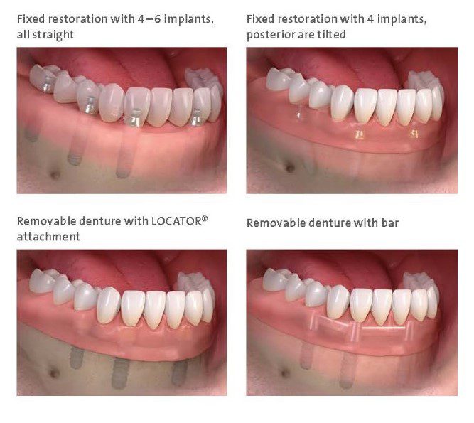 Dental implants