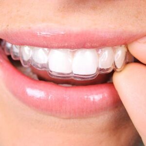 Clear Dental Aligners on Teeth