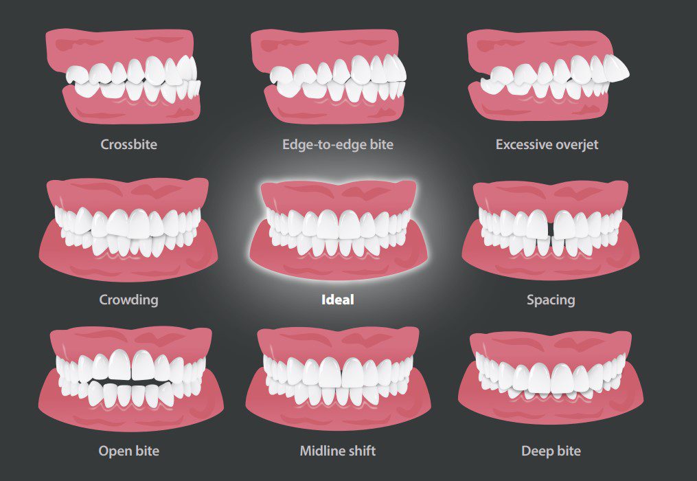 Types of dental malocclusions