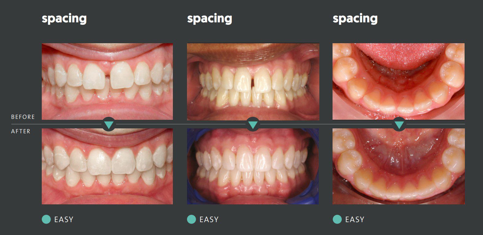 Before and after dental spacing correction